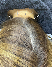 MT-MPS（深層筋調整）・トリガーポイント鍼灸の特徴写真１